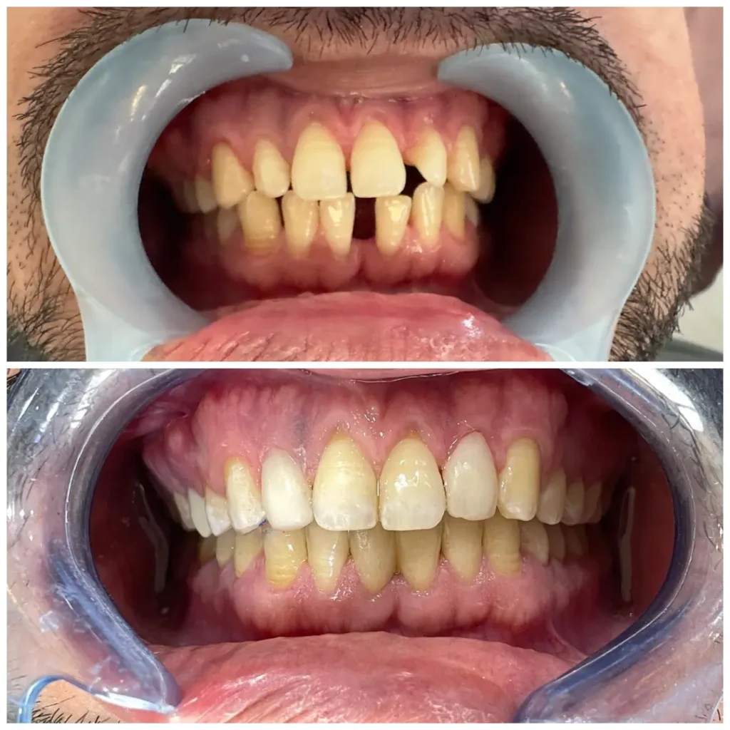 braces in islamabad