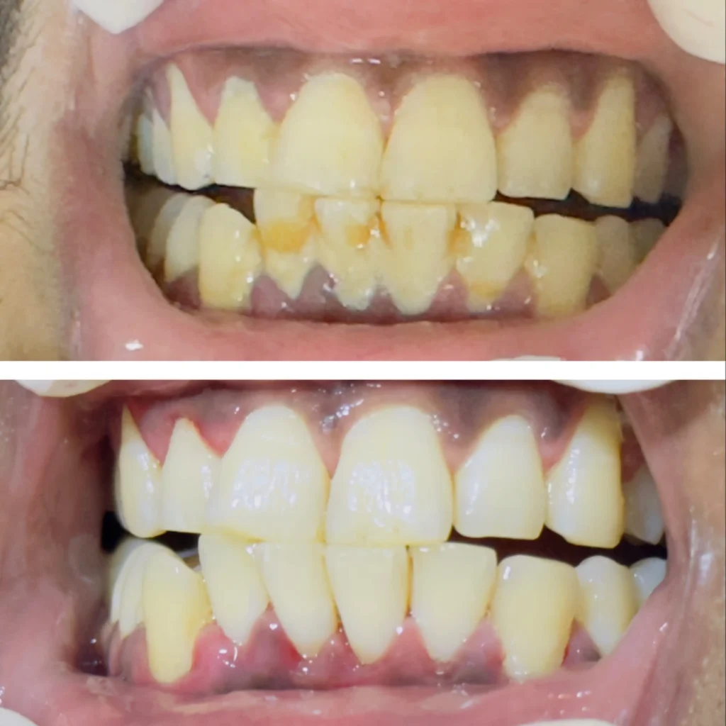 teeth cleaning